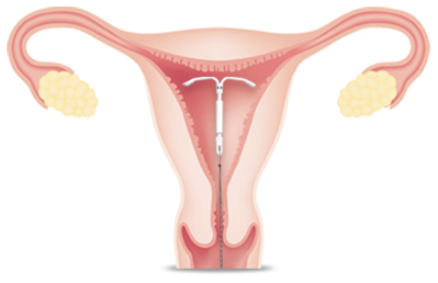 iud placement in uterus