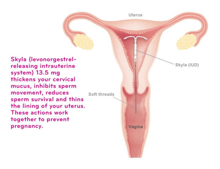 IUD placement